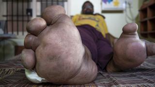 My Leg Weighs 200 Pounds My Leg Weighs 200 Pounds