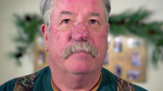 Every Rosacea Has Its Thorn Every Rosacea Has Its Thorn