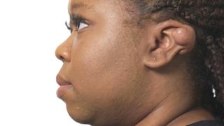 Abscessive Compulsive Abscessive Compulsive