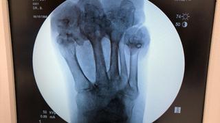 Little Toe Needs Help! Little Toe Needs Help!