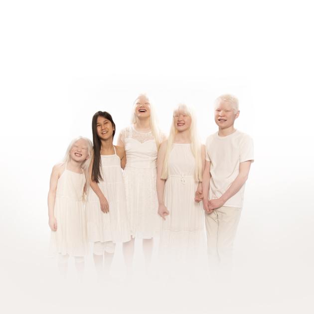 Born With Albinism