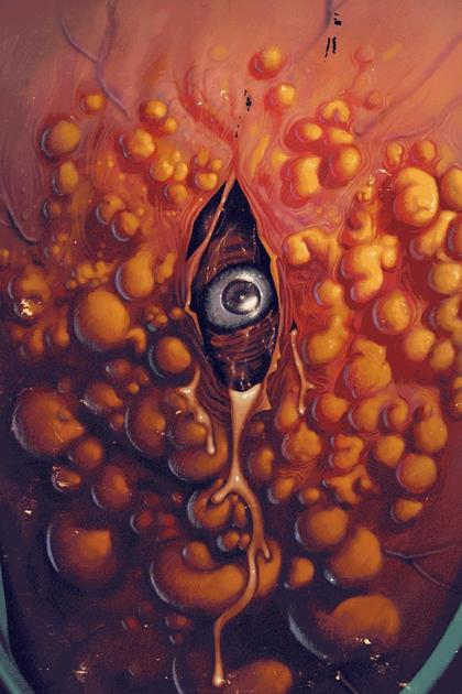 Cyst