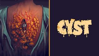 Cyst