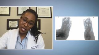 Achy Break-y Feet