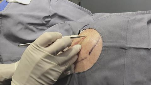 This is Zit: The Traveling Lipoma