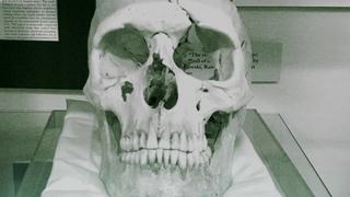 Phineas Gage's Skull
