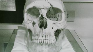 Phineas Gage's Skull Phineas Gage's Skull