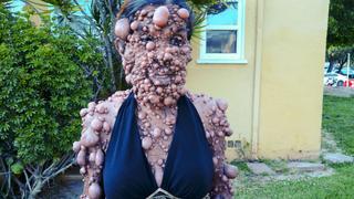 The Woman Covered in Thousands of Tumors The Woman Covered in Thousands of Tumors