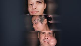 A Tumor Invader A Tumor Invader